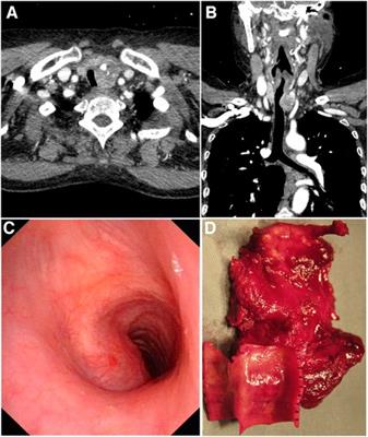 Sleeve resection with end-to-end anastomosis in the reconstruction of tracheal defects exceeding six rings: a clinical feasibility study and safety assessment